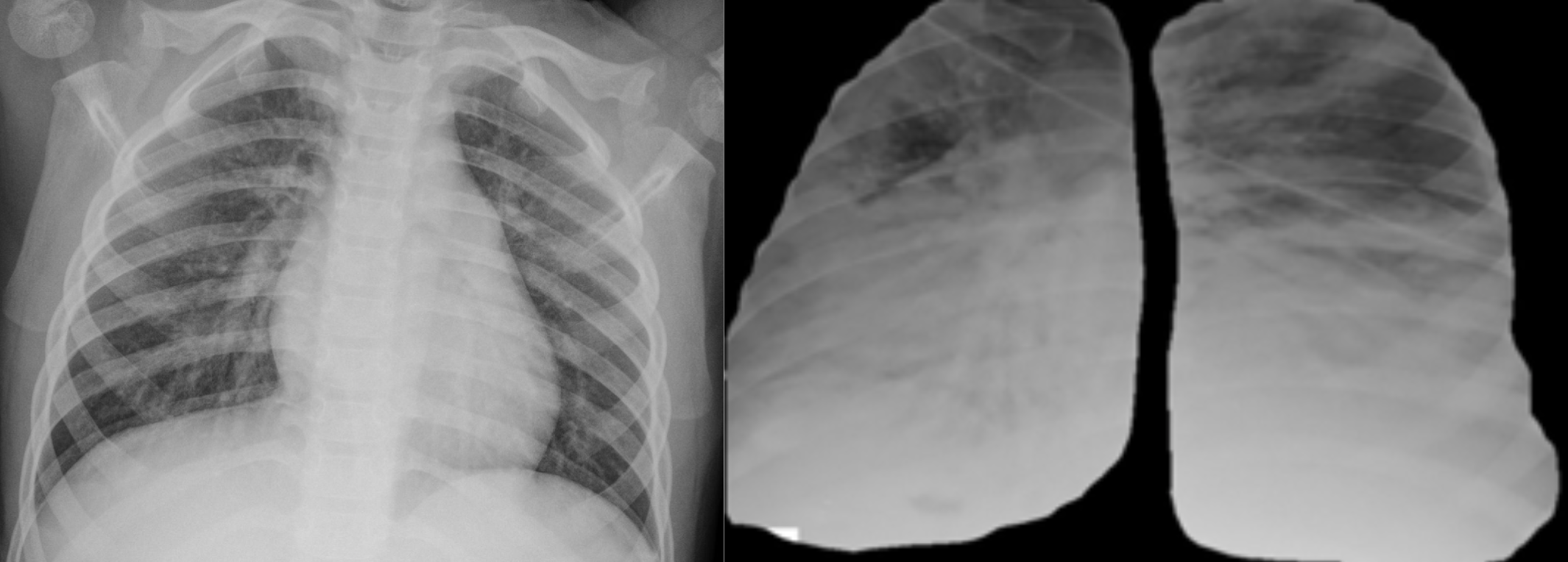 Left: Unlabeled chest X-ray with heart and other organs present. Right: Masked-normalized lungs, achievable thanks to the segmentation annotations. These can greatly improve the performance of classification.